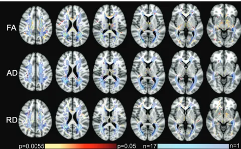 FIG 1. Correlations among FA, RD, AD, and mVEP. Shown are the tract-based spatial statistics results of the correlation analysis and the MS lesionpresented in violet to turquoise