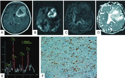 Table 1: Threshold values for multiple parameters for differentiating high- and low-grade gliomas