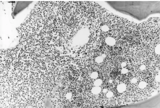 Figure 1. Peripheral blood, 100 £ (oil). At high power, this circulating hairy cell has a sharply circumscribed oval nucleus, ‘textured’-appearing cytoplasm and nearly circumferential villous cytoplasmic extensions, or