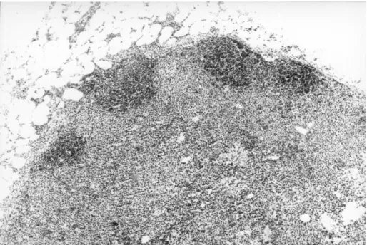 Figure 5. Lymph node, 10 £ . Hairy cell leukaemia occurs in an interfollicular and paracortical pattern