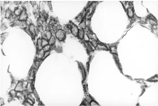 Figure 6. Bone marrow, CD20 immunostain, 100 £ (oil). The immunostain demonstrates a strong and coarse membrane pattern staining of the interstitially distributed cells