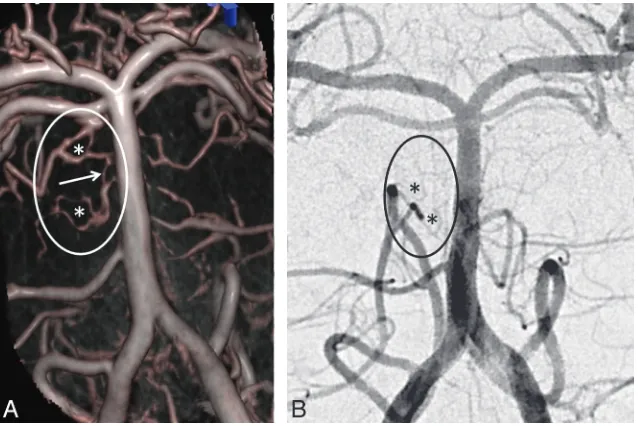 FIG 1. Segmental pattern and descending course of circumferential pontine arteries (arrows) onvolume rendering reconstructions of a DynaCT dataset of the basilar artery in Towne and lateralprojection.