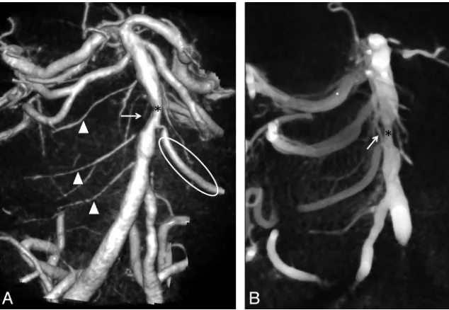 FIG 3. Axial cuts of DynaCT dataset with thin sections of 3 mm reconstructed from 3D rotational angiogram shows ventral pontine perforators(bright arrows) originating from the basilar artery (*) at the junction between mesencephalon and pons (A), at the midpontine level (B), and at thevertebrobasilar junction (C).