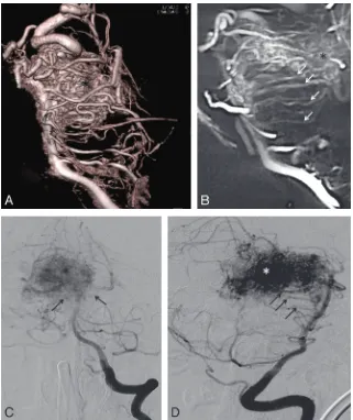 FIG 5. Volume rendering reconstruction (multiple hypertrophied circumferential pontine arteries (supply of a mesencephalic AVM (*)