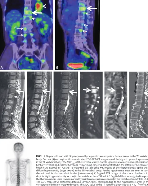FIG 2. A 54-year-old man with biopsy-proved hyperplastic hematopoietic bone marrow in the T11 vertebralOn the sagittal reconstructed CT image of the thoracolumbar spine, there is diffuse, slightly high attenuationin the T11 vertebral body (thoracic and lum