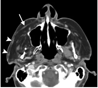 FIG 12. Fascia lata graft. Intraoperative photograph shows the pre-pared fascia lata graft (arrow) over its planned course toward the leftnasal ala before implantation.