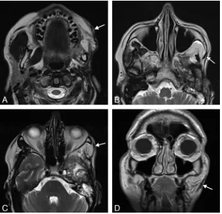 FIG 15. Temporalis ﬂap. Axial T2 MR imaging (A–C) and coronal T1 MR imaging (D) show that the left temporalis muscle with the overlying fascia(arrows) is directed retrograde from the temporal fossa to the orbicularis oris.