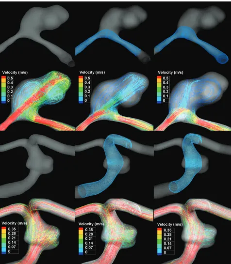 FIG 3. Hemodynamic modiﬁcation by FD showing streamlines with ﬂow-velocity magnitude (second and fourth rows) in the sidewall andfusiform aneurysms