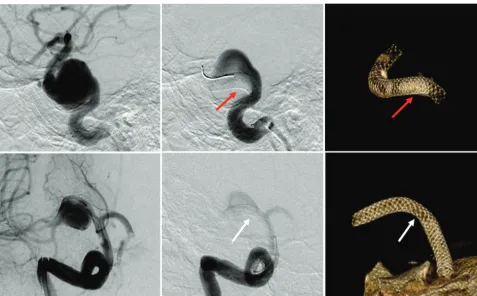 FIG 4. Two clinical PED cases using DPPT. Left and middle: pre- and posttreatment angiography