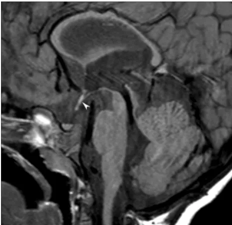 FIG 5.Midsagittal T1-weighted image of the patient harboring the14q22.1-q23.1 deletion shows a small and short midbrain with elon-gated pons and relatively larger superior portion of the cerebellarvermis