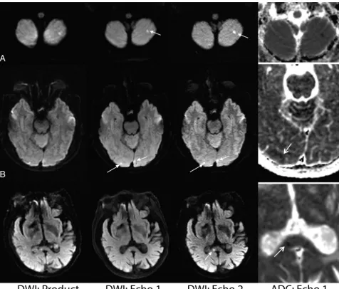 FIG 3. Comparison of the vendor-supplied (product) DWI, echo 1, and echo 2 DWI acquired from the dual-echo sequence on 3 patients (fromleft to right)