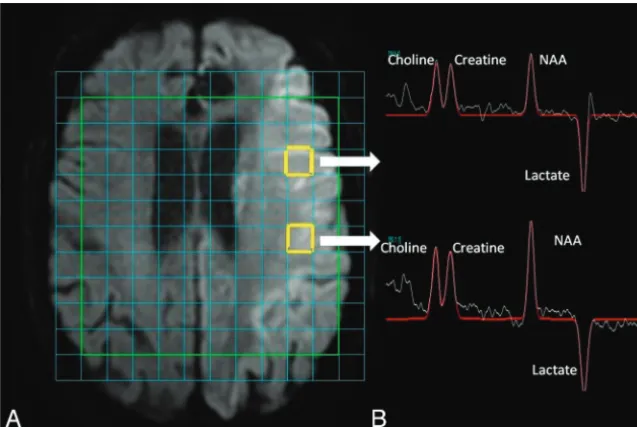 FIG 2. Data from MRS. A, Acute stroke lesion of the left hemisphere on DWI. There is a multi-voxel spectroscopy grid overlaid onto the time