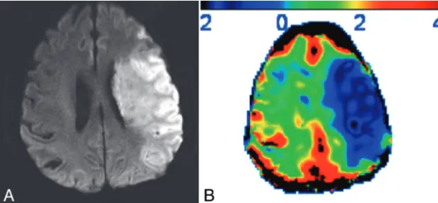 FIG 3. An example of oxygen challenge imaging. A, Stroke lesion of the left hemisphere on DWIfrom a subject last seen well approximately 24 hours before imaging