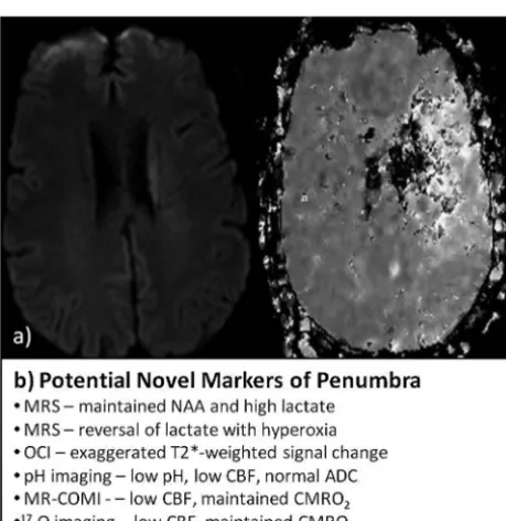 FIG 4. Current and potential markers of core. A, MR images of DWI(right) and FLAIR image (left) showing extensive established infarctcore; B, list of potential imaging proﬁles that may reﬁne deﬁnitions ofcore