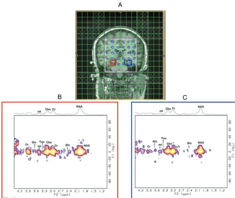 FIG 2. A, Spatial distribution of 2D diagonal peaks of Cr and Cho from the CS reconstruction of a prospectively undersampled with 4�acceleration of the 4D EP-JRESI scan of a 39-year-old healthy control overlaid on the T1-weighted coronal MR image, with the white boxindicating PRESS localization; selected 2D J-resolved spectra were extracted from the right (B) and left hippocampi (C).