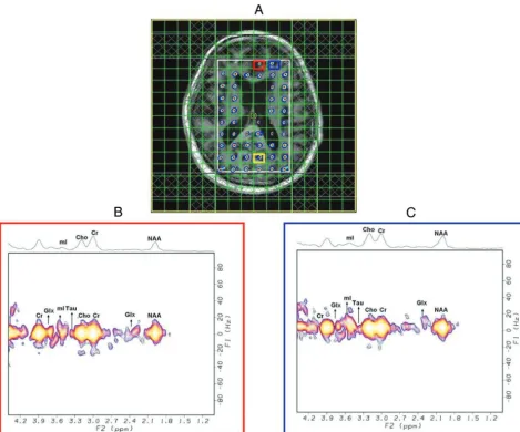 FIG 4. Reconstruction of an undersampled 4D EP-JRESI in vivo brain scan of a 69-year-old patient with OSA with only 25% of the samples as(required by the Nyquist-Shannon criterion, showing multivoxel spatial distribution of diagonal NAA peaks overlaid on t