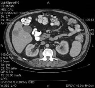 Figure 1:CT image showing multiple low density lesions in the  liver.