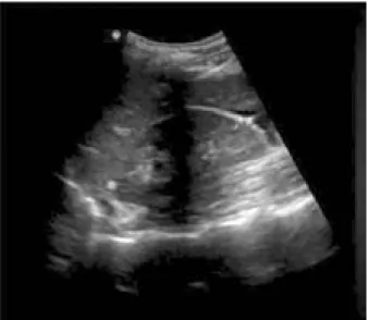 Figure 1: A positive Focused Assessment with Sonography for  Trauma (FAST) examination