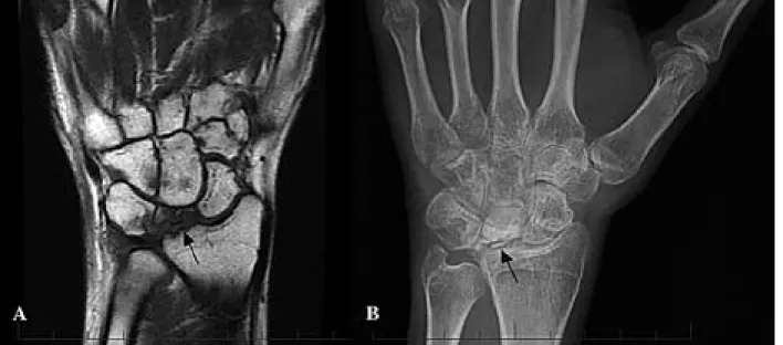 Figure 1: A. Coronal T1-weighted fast-spin-echo magnetic resonance image showing collapse of the lunate with mixed signal in- in-tensity suggesting sclerosis and edema consistent with Kienbock’s disease (arrow)