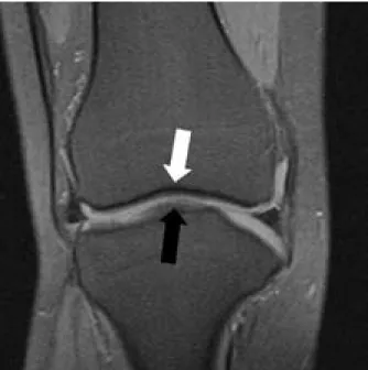 Figure 2:  Lateral  right  knee  radiograph  with  the  patient  posi- posi-tioned in right lateral decubitus reveals normal alignment without  subluxation of the tibia on the femur