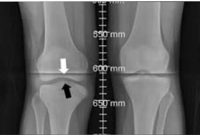 Figure 3:  Coronal  proton  density  fat-suppressed  MRI  demon- demon-strates a shallow femoral intercondylar notch (white arrow),  absent intercondylar eminence (black arrow) and a downward  slope of the medial tibial condyle