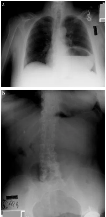 Figure 2.  a) Chest x-ray showing stomach shadow in the thoracic area. 