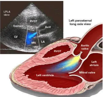 Figure 3 A typical Doppler echocardiograph in a MFS patient.  The aortic valve regurgitation is apparent