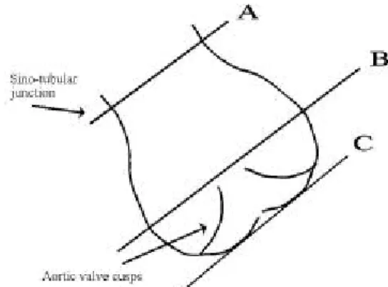 Figure  5.  Echocardiographical measurements are made at A, B and C but the width at B determines the need for surgical intervention.