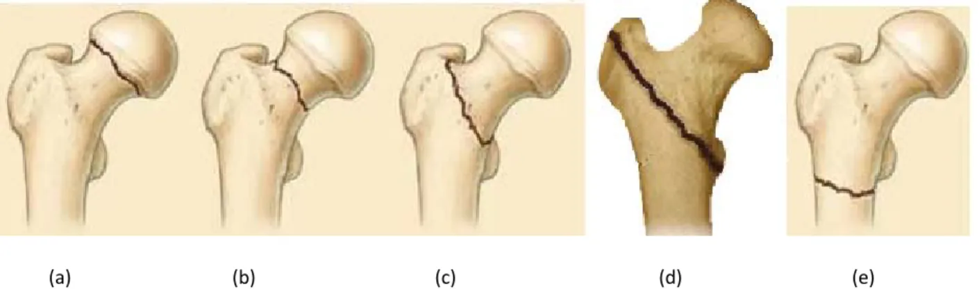 Figure 3.3.2 Four types of proximal femur fractures: (a) subcapital neck fracture [47], (b) transcervical neck  fracture [47], (c) basicervical neck fracture [47], (d) intertrochanteric fracture [48], (e) subtrochanteric  fracture [47] 