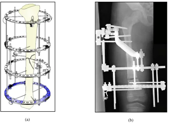Figure 4.2.1 External fixation: (a) illustration demonstrating application [53], (b) x-ray picture showing  fracture of femur fixed with external fixator [54] 