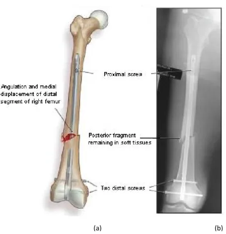 Figure 4.2.3 Retrograde nailing: (a) illustration demonstrating completed implant, (b) X- X-ray picture of retrograde nailing [55]