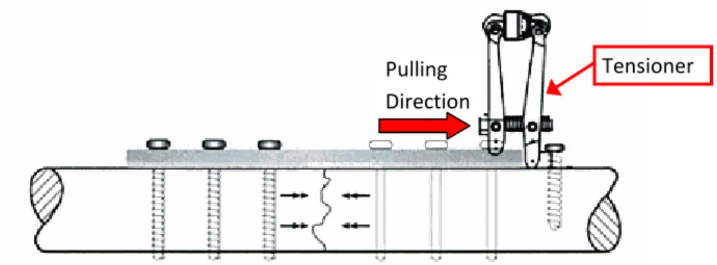 Figure 4.2.6 Compression plate secured with bone screws and pulled by tensioner [6] 